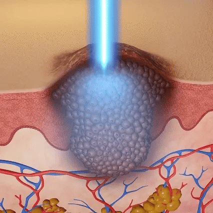 ACEZOZLA™ non-invasive laser pen delivers hospital-grade results at home