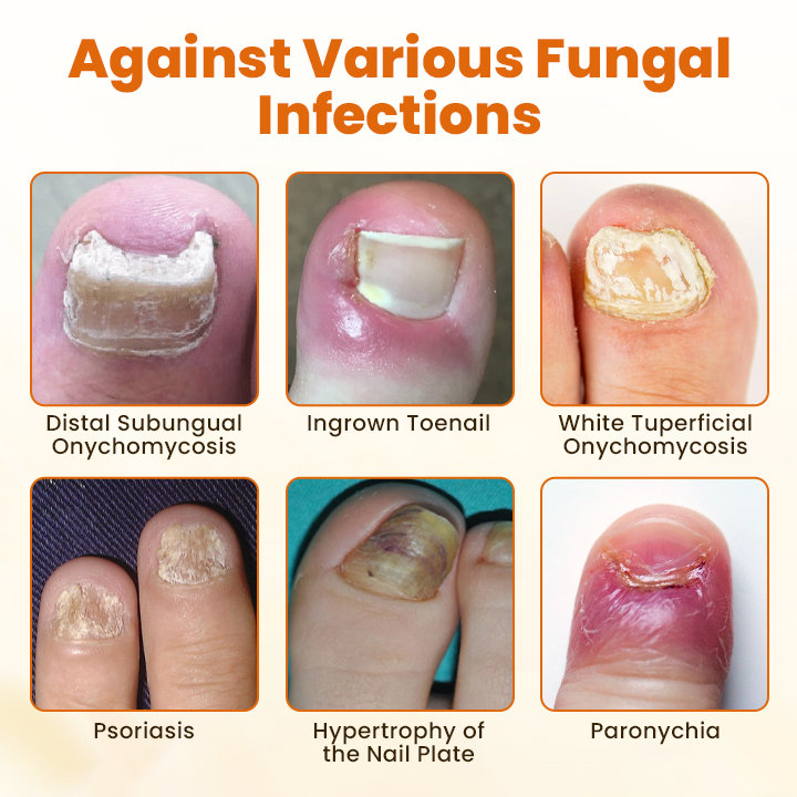 Acezozla® FungiBee Advanced Nail Repair Spray