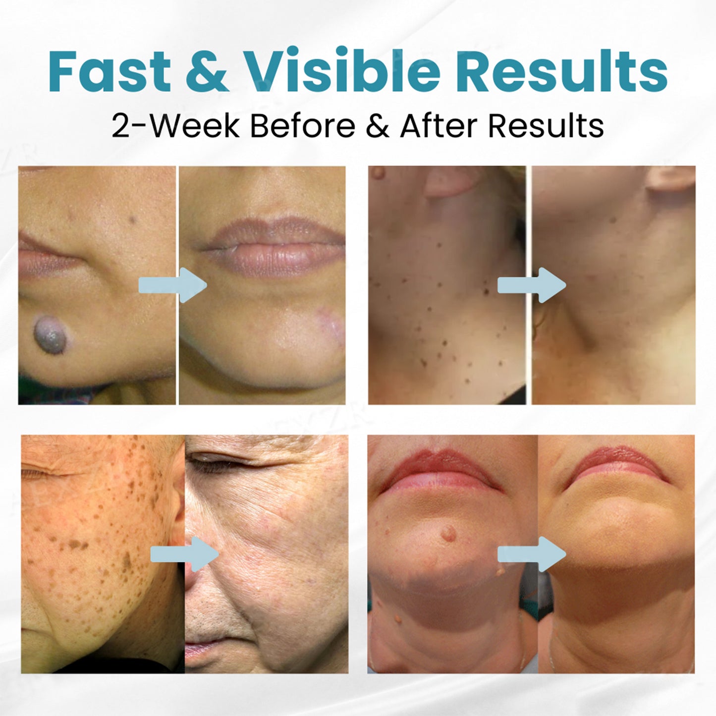 ACEZOZLA™ non-invasive laser pen delivers hospital-grade results at home